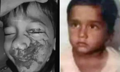 कुत्ते ने मासूम का जबड़ा नोंचा, दांत भी खा गए,भोपाल में 6 साल के बच्चे पर हमला, जबड़े पर 20 टांके आए.. October 7, 2026
