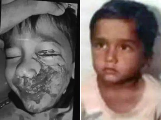 कुत्ते ने मासूम का जबड़ा नोंचा, दांत भी खा गए,भोपाल में 6 साल के बच्चे पर हमला, जबड़े पर 20 टांके आए.. October 7, 2026