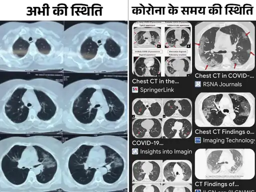 MP में कोरोना वायरस जैसा संक्रमण, स्ट्रेन में बदलाव,4 दिन के बुखार में लंग्स में 40% इन्फेक्शन, दो सीटी स्कैन इमेज से समझें कोराना और वर्तमान स्थिति October 19, 2026
